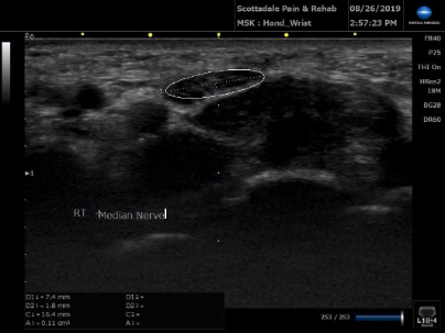 Ultrasound Right Median Nerve