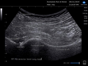 Ultrasound anterior hip joint