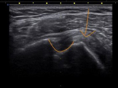 Ultrasound Biceps tendons
