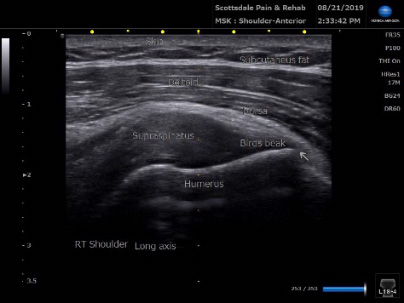 Ultrasound Supraspinatus tendon