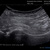 Ultrasound anterior hip joint