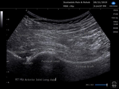 Ultrasound anterior hip joint