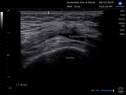 Ultrasound Suprapatellar recess above knee cap