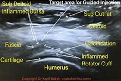 Ultrasound Image of the Shoulder